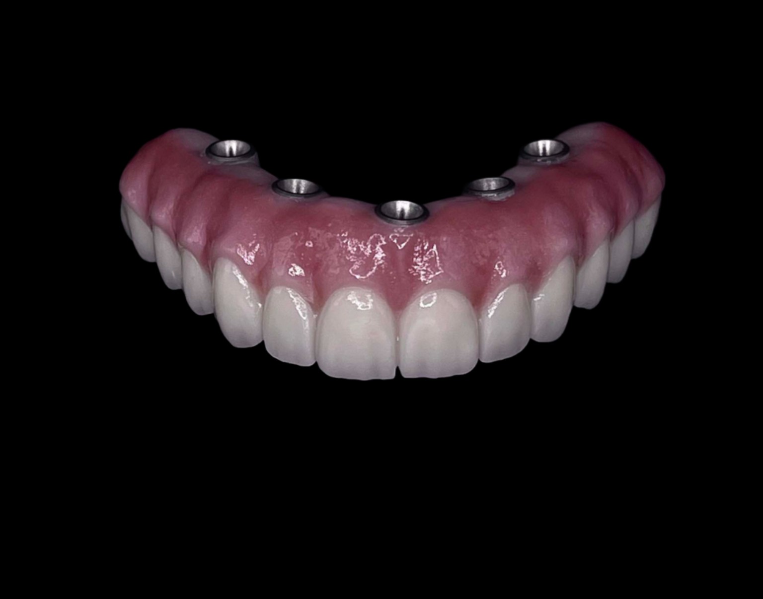 Rezultat fix pe implanturi