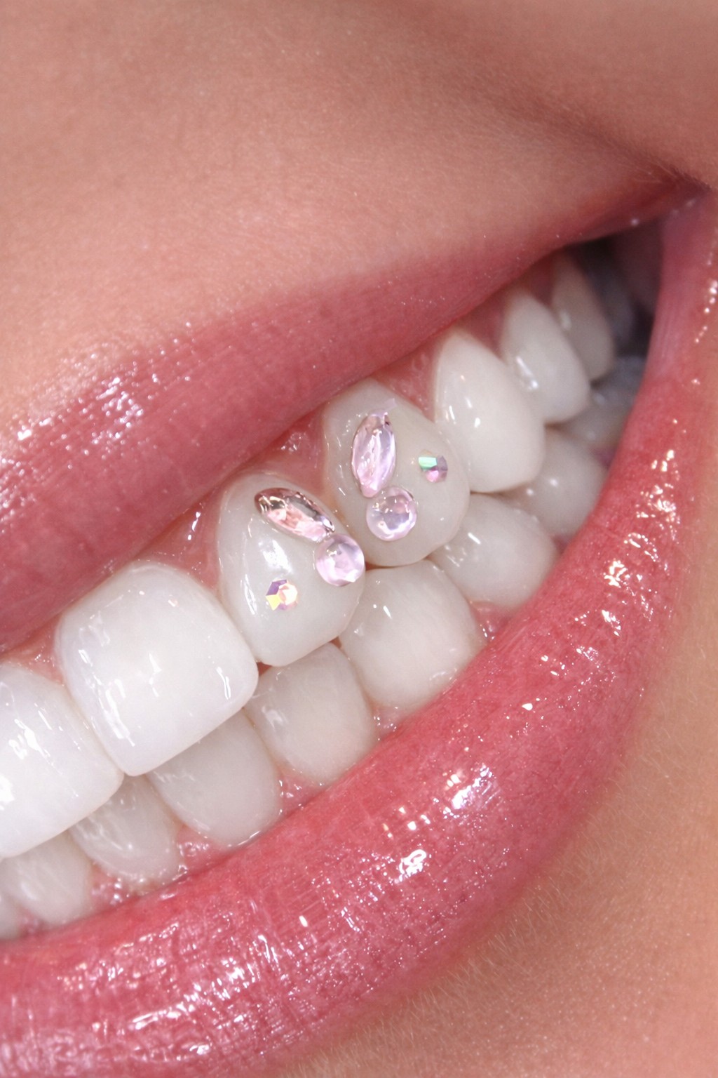 Albire dentară & bijuterie dentară