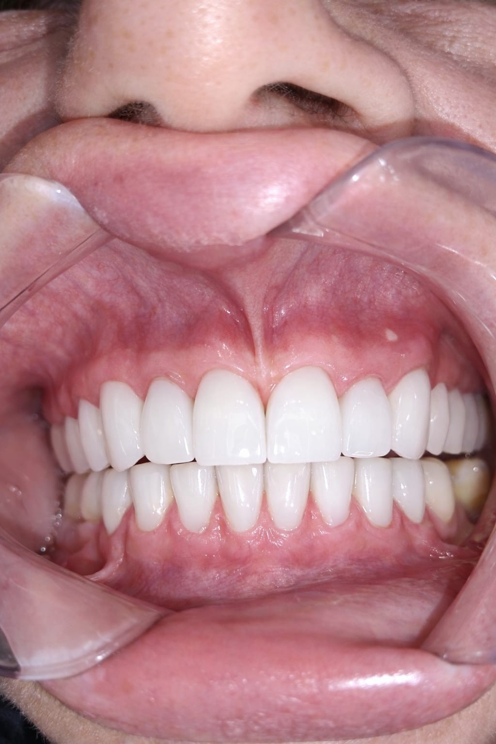 Albire Dentară Profesională în București — Dinți Mai Albi cu până la 8 Nuanțe